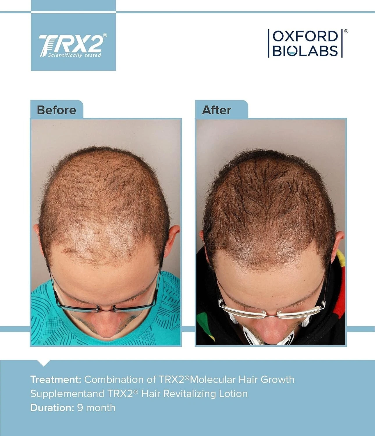 Oxford Biolabs TRX2® Molecular Food Supplement for Hair, 90 Capsules 1 Month Supply - Image 3
